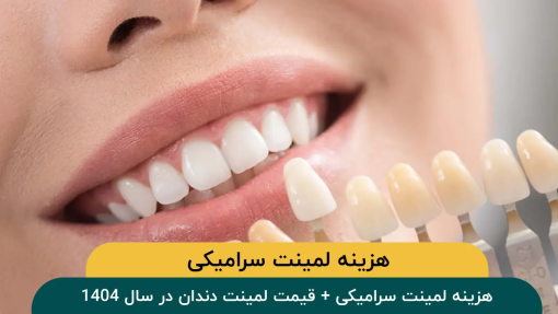 قیمت-لمینت-دندان